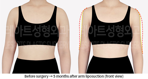 arm_liposuction_02_02_240712