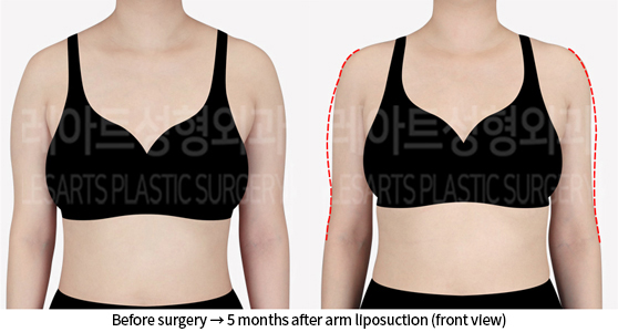 arm_liposuction_02_02_240723