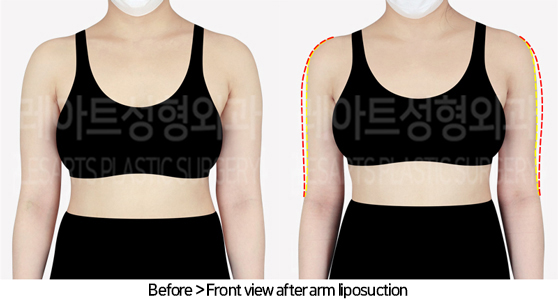 arm_liposuction_02_02_240725