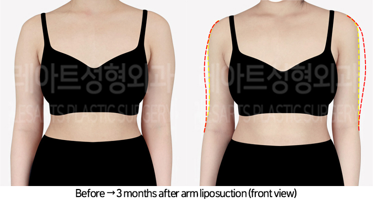 arm_liposuction_02_02_240729