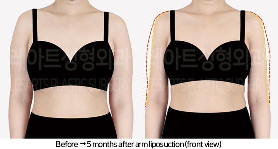 arm_liposuction_02_02_240731