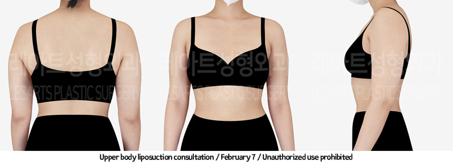 arm_liposuction_02_03_231226