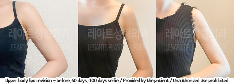 arm_liposuction_02_03_240105
