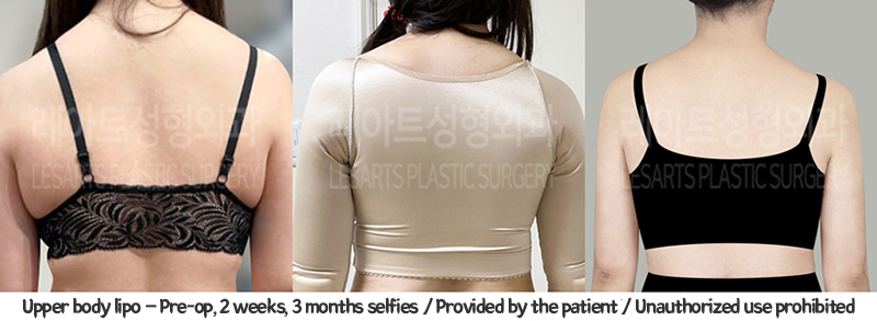 arm_liposuction_02_03_240117