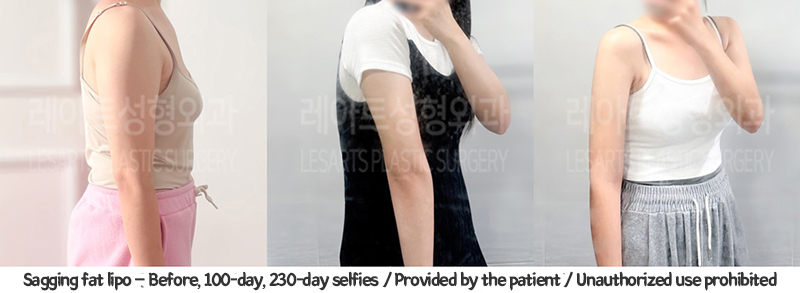 arm_liposuction_02_03_240129