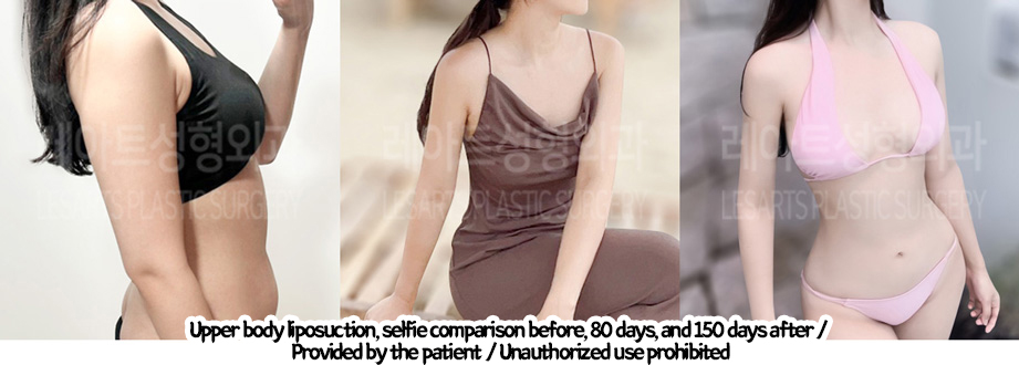 arm_liposuction_02_03_240219