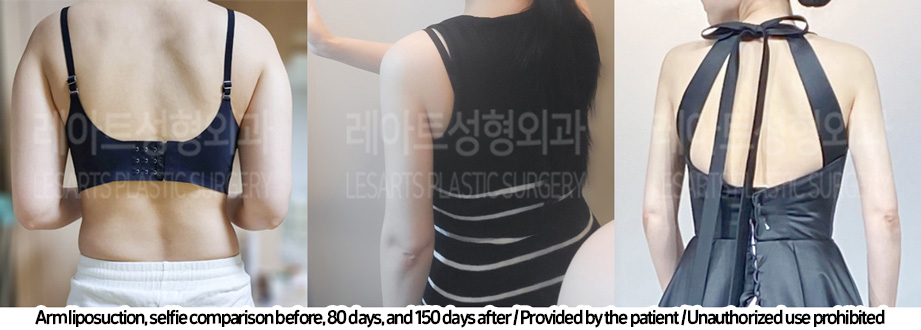 arm_liposuction_02_03_240219_2