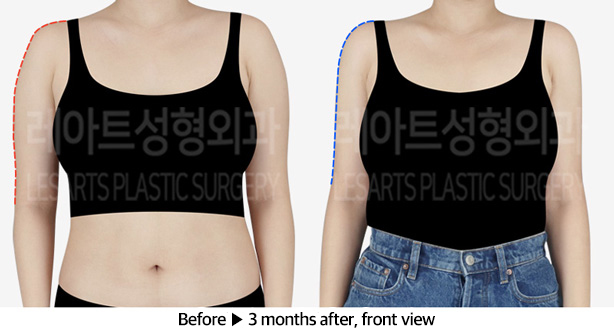 arm_liposuction_02_03_240223