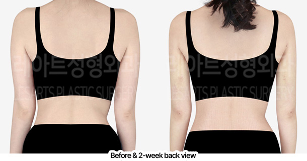 arm_liposuction_02_03_240228