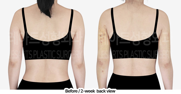 arm_liposuction_02_03_240229