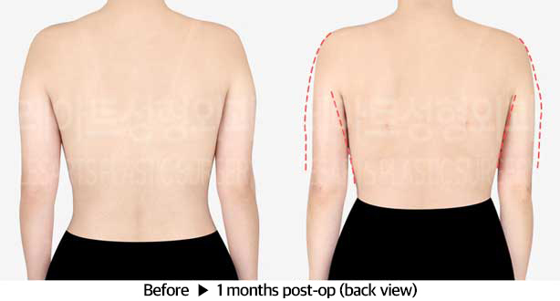 arm_liposuction_02_03_240326