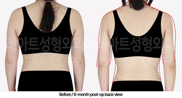 arm_liposuction_02_03_240509