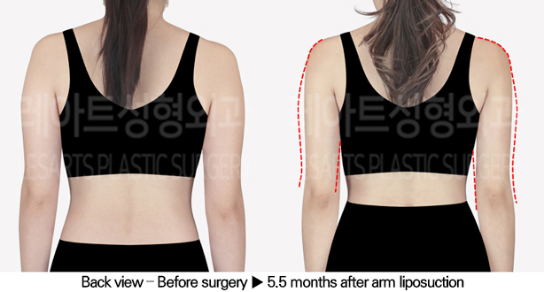 arm_liposuction_02_03_240520