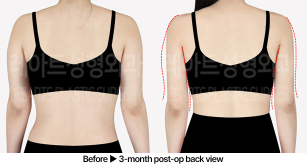 arm_liposuction_02_03_240531