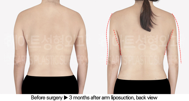 arm_liposuction_02_03_240617