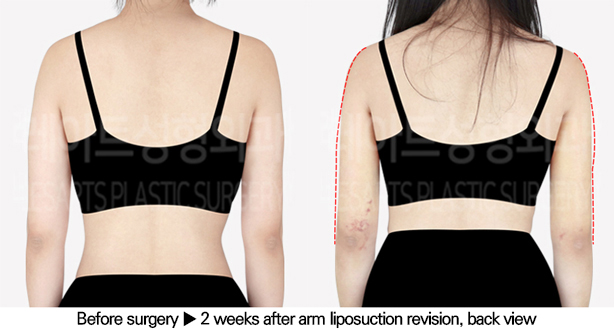 arm_liposuction_02_03_240625