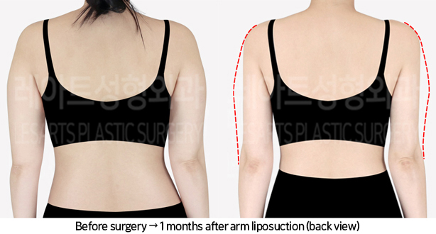 arm_liposuction_02_03_240705