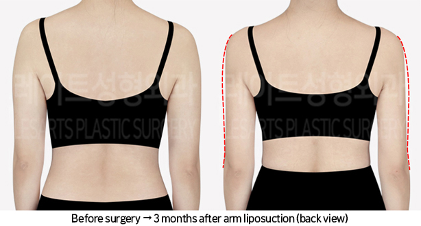 arm_liposuction_02_03_240709