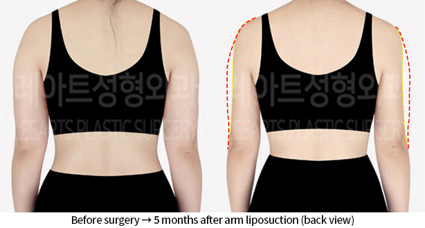 arm_liposuction_02_03_240712