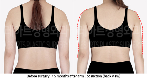 arm_liposuction_02_03_240723