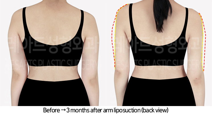 arm_liposuction_02_03_240729