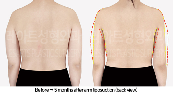 arm_liposuction_02_03_240731
