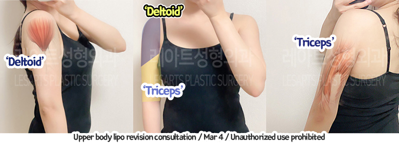 arm_liposuction_02_04_240105