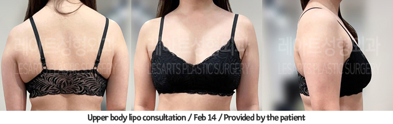 arm_liposuction_02_04_240117