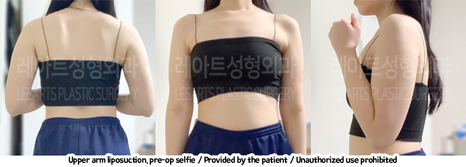 arm_liposuction_02_04_240208