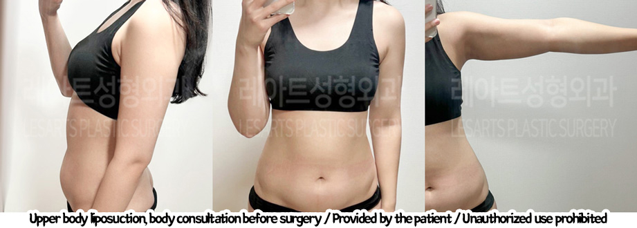 arm_liposuction_02_04_240219