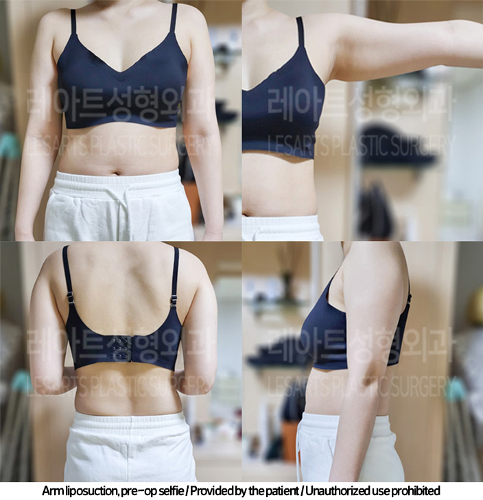 arm_liposuction_02_04_240219_2