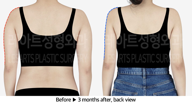 arm_liposuction_02_04_240223