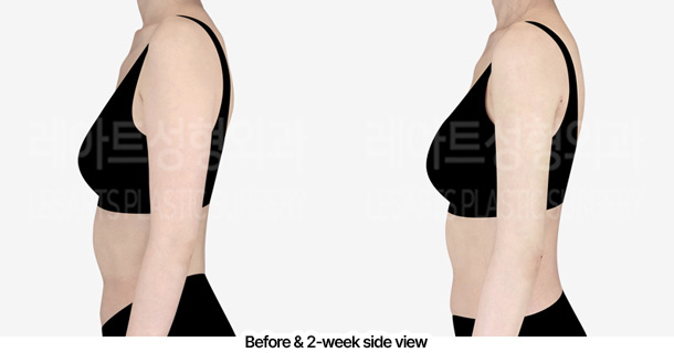 arm_liposuction_02_04_240228