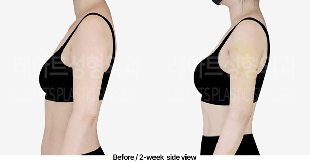 arm_liposuction_02_04_240229