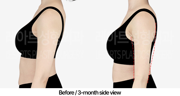 arm_liposuction_02_04_240422