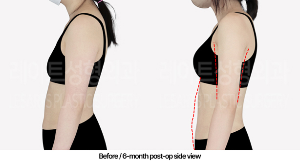 arm_liposuction_02_04_240509