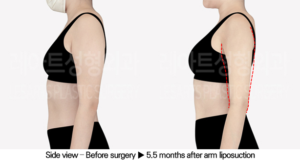 arm_liposuction_02_04_240520