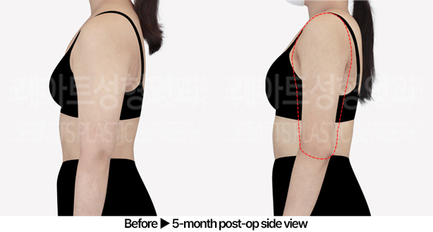 arm_liposuction_02_04_240527