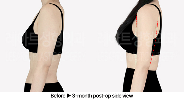 arm_liposuction_02_04_240531