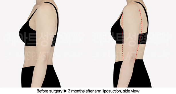 arm_liposuction_02_04_240611