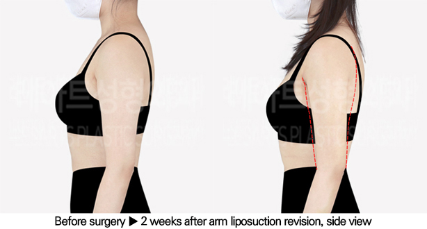 arm_liposuction_02_04_240625