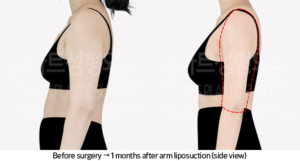 arm_liposuction_02_04_240705