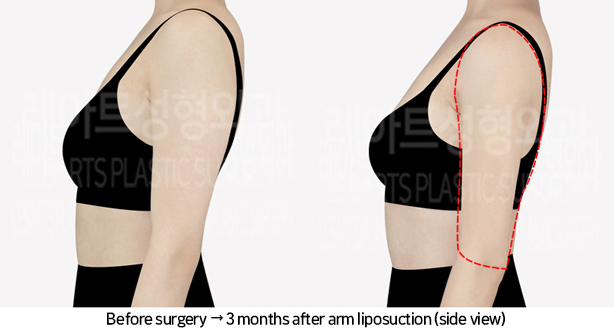 arm_liposuction_02_04_240709