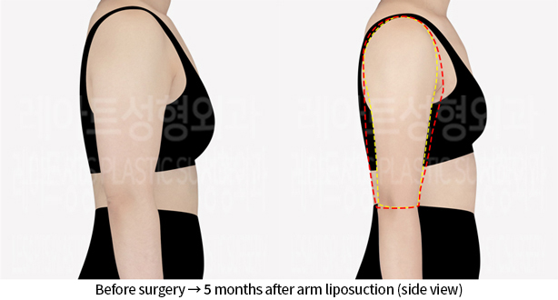 arm_liposuction_02_04_240712