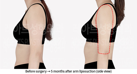 arm_liposuction_02_04_240723