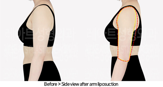 arm_liposuction_02_04_240725