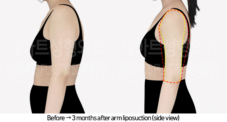 arm_liposuction_02_04_240729