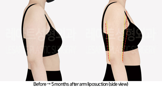 arm_liposuction_02_04_240731