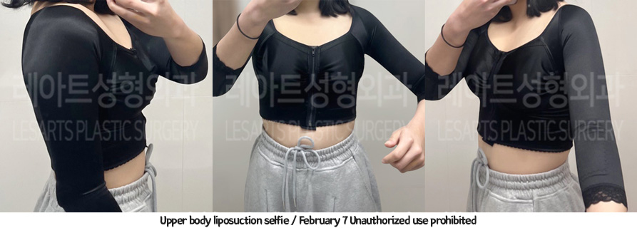 arm_liposuction_02_05_231226