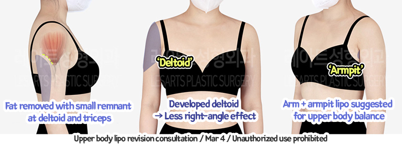 arm_liposuction_02_05_240105